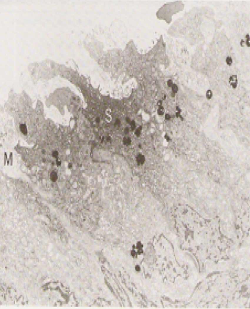 Electron microscopy of olfactory epithelium of patient with hyposmia (loss of smell)